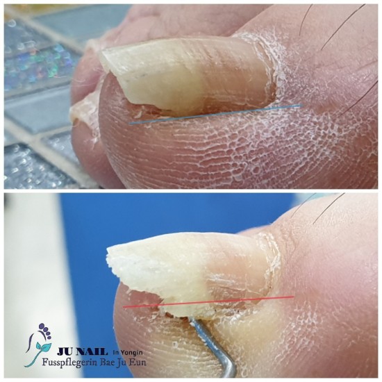 발톱이 파고들어 너무아픈데 병원이 무서워요./분당용인수원수지보정동백죽전동/주네일/무좀파고드는내향성발톱손톱변형전문네일샵 발톱이 파고들어 너무아픈데 병원이 무서워요./분당용인수원수지보정동백죽전동/주네일/무좀파고드는내향성발톱손톱변형전문네일샵