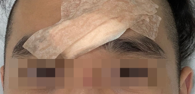  미주신경성 실신
