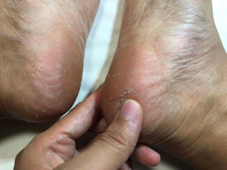 발뒤꿈치각질제거 후기 (약혐주의) 6