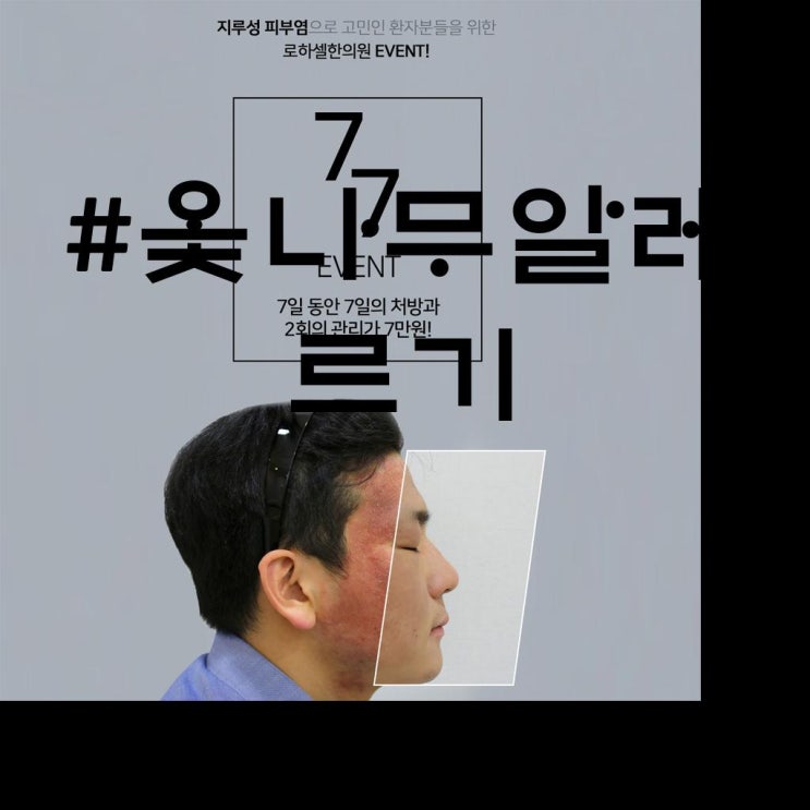  옻나무알레르기?때문에 한의원 다니고 효과보고 있음