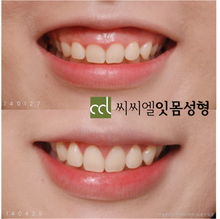  거미스마일, 웃을 때 잇몸이 보여서 사진이 두려운 당신