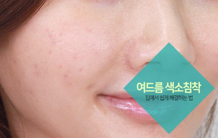  여드름 색소침착 이렇게 케어하고 고민 끝