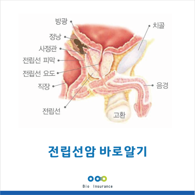  전립선암 바로알기