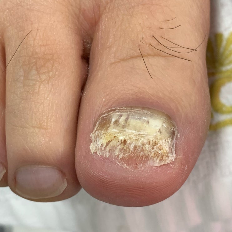  무좀발톱은 부천어딕션네일에서 관리하세요