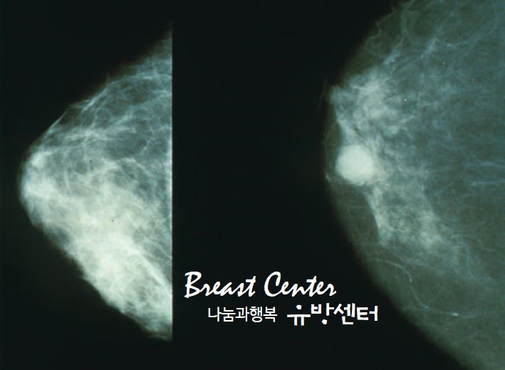 유방의 엽상종양... 공격적인가요 악성인가요? 2