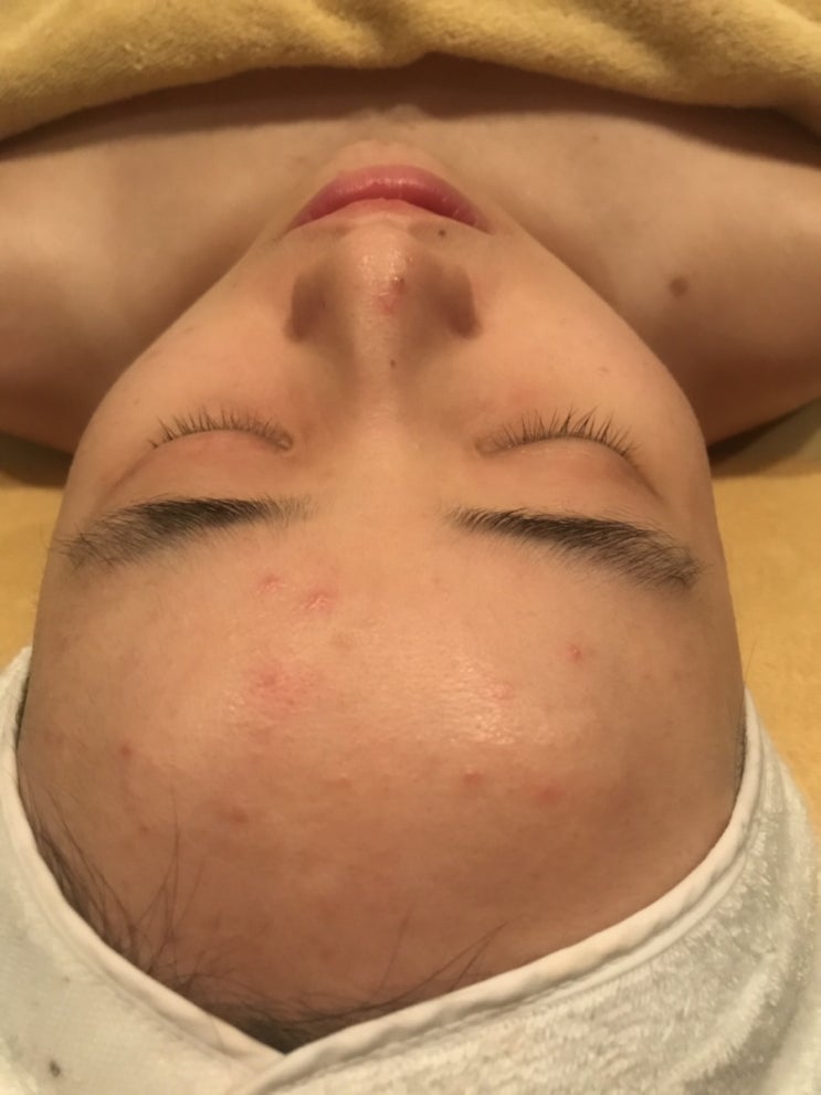  한남동 피부관리 스파데이 트러블케어로 비포 애프터 확실하게 확인하기!