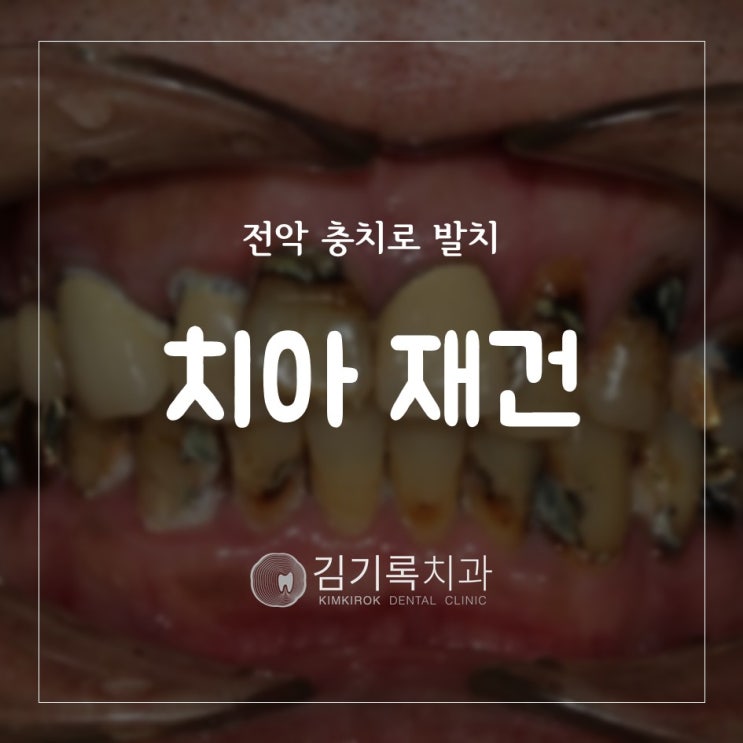 수원내비게이션임플란트 전악 충치로 발치 후 전체 임플란트로 재건했어요