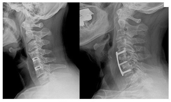 목디스크 시술 제 시술 후기/건강 유의하세요.