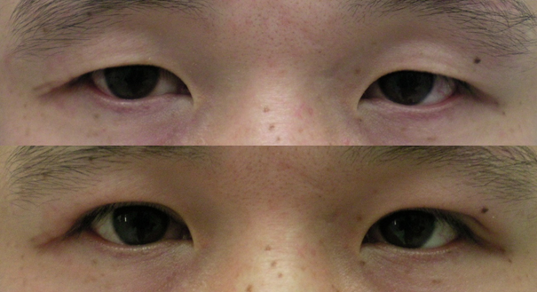 남자의 쌍꺼풀 수술 2 : 속쌍꺼풀이 좀더 자연스럽다 : 네이버 블로그