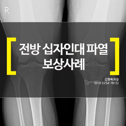  [대전손해사정] 전방 십자인대 파열 보상사례