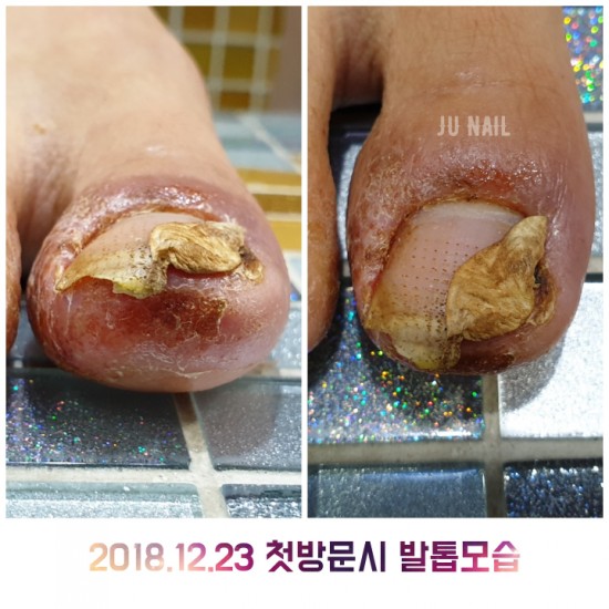 한달만에너무아픈염증발톱으로변했어요/분당용인수원수지보정동백죽전동/주네일/파고드는발톱전문네일샵