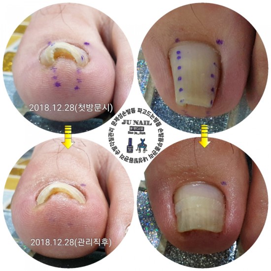 발톱수술은너무무섭습니다./분당용인수원수지보정동백죽전동/주네일/파고드는발톱전문네일샵