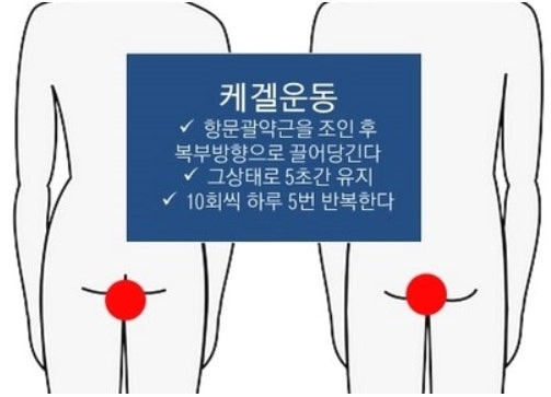 케켈운동으로 요실금과 치질을 예방한다