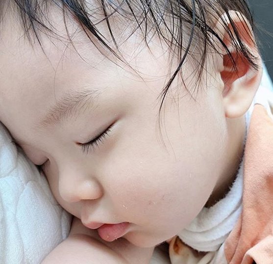  입술이 부었어요, 아기 피부 밥도 못 먹을까봐 걱정이네요