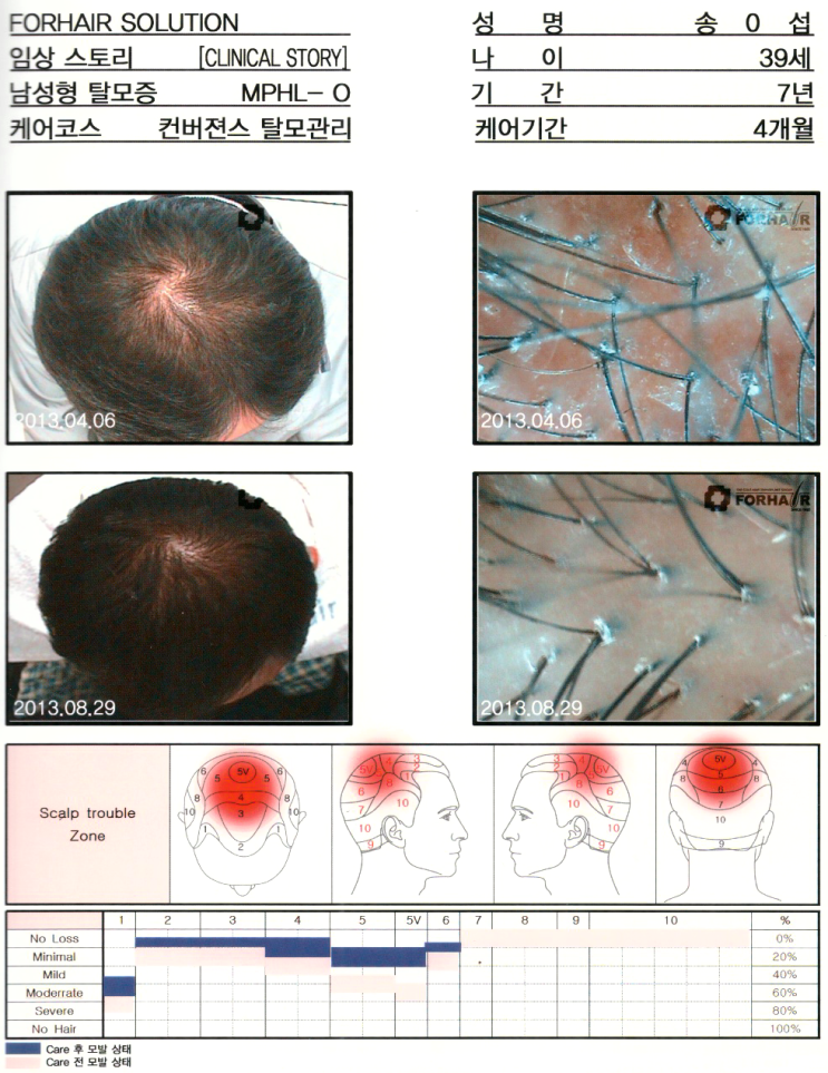 화학적인 탈모,피부염 탈모,방화 탈모,방화역 탈모,방화동 탈모,강서구탈모,닥터포헤어,가양역점,탈모진단,탈모관리,유전자검사,두피관리,남성탈모 화학적인 탈모,피부염 탈모,방화 탈모,방화역 탈모,방화동 탈모,강서구탈모,닥터포헤어,가양역점,탈모진단,탈모관리,유전자검사,두피관리,남성탈모