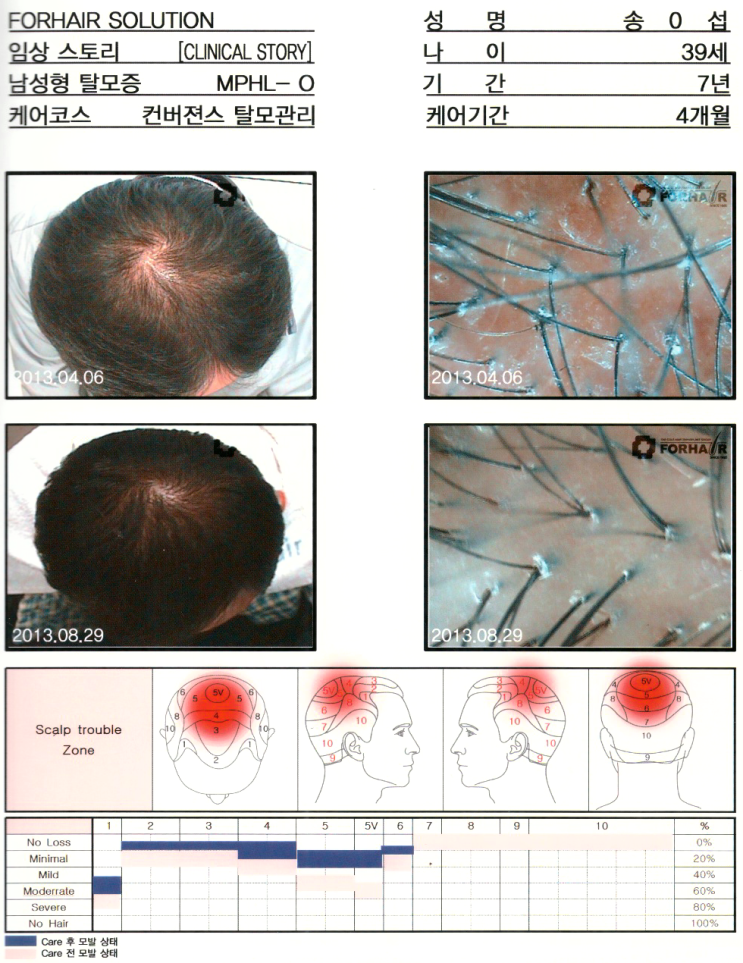 화학적인 탈모,피부염 탈모,방화 탈모,방화역 탈모,방화동 탈모,강서구탈모,닥터포헤어,가양역점,탈모진단,탈모관리,유전자검사,두피관리,남성탈모