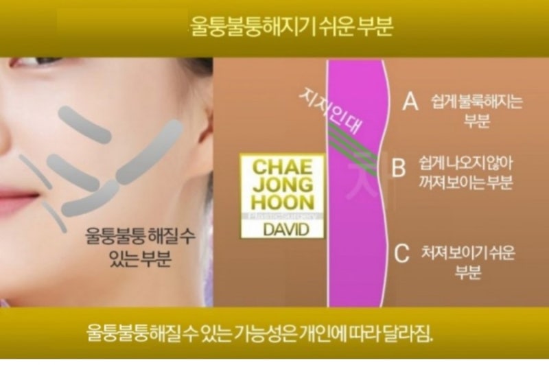 부산 티타늄 리프팅 시술 후 바로 느껴지는 턱선 변화! (내돼지내산 후기) 부산 티타늄 리프팅 시술 후 바로 느껴지는 턱선 변화! (내돼지내산 후기)