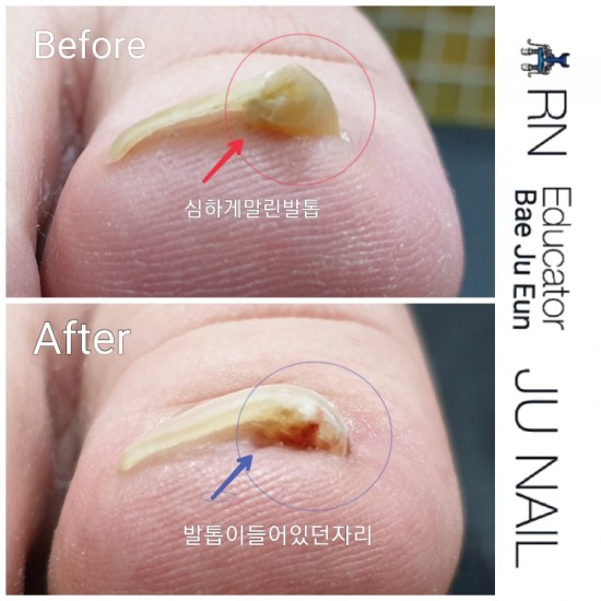 발톱이파고들어반으로꺽여있어요.이발톱도가능할까요?/분당용인수원수지보정동백죽전동/주네일/파고드는발톱전문네일샵 발톱이파고들어반으로꺽여있어요.이발톱도가능할까요?/분당용인수원수지보정동백죽전동/주네일/파고드는발톱전문네일샵