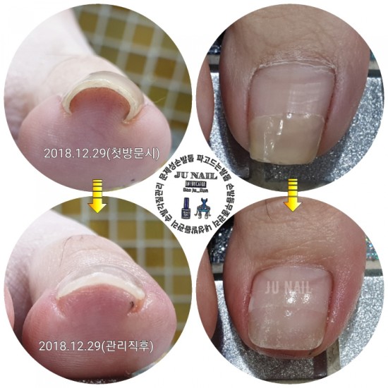 발톱이아파서솜끼우고다녔는데5개월만에너무심해졌어요/분당용인수원수지보정동백죽전동/주네일/파고드는발톱전문네일샵 발톱이아파서솜끼우고다녔는데5개월만에너무심해졌어요/분당용인수원수지보정동백죽전동/주네일/파고드는발톱전문네일샵