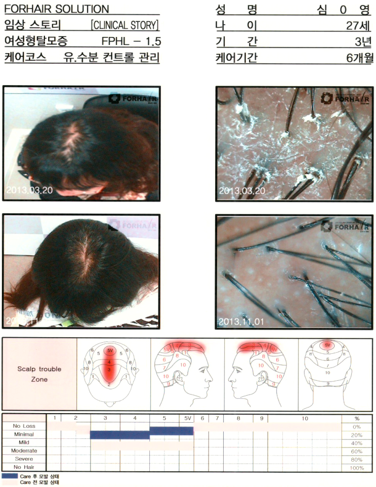 탈모증의 원인과 정의,마곡나루역 탈모,공항시장역 탈모,까치산역 탈모,강서구탈모,닥터포헤어,가양역점,탈모진단,탈모관리,탈모검사,두피관리 탈모증의 원인과 정의,마곡나루역 탈모,공항시장역 탈모,까치산역 탈모,강서구탈모,닥터포헤어,가양역점,탈모진단,탈모관리,탈모검사,두피관리