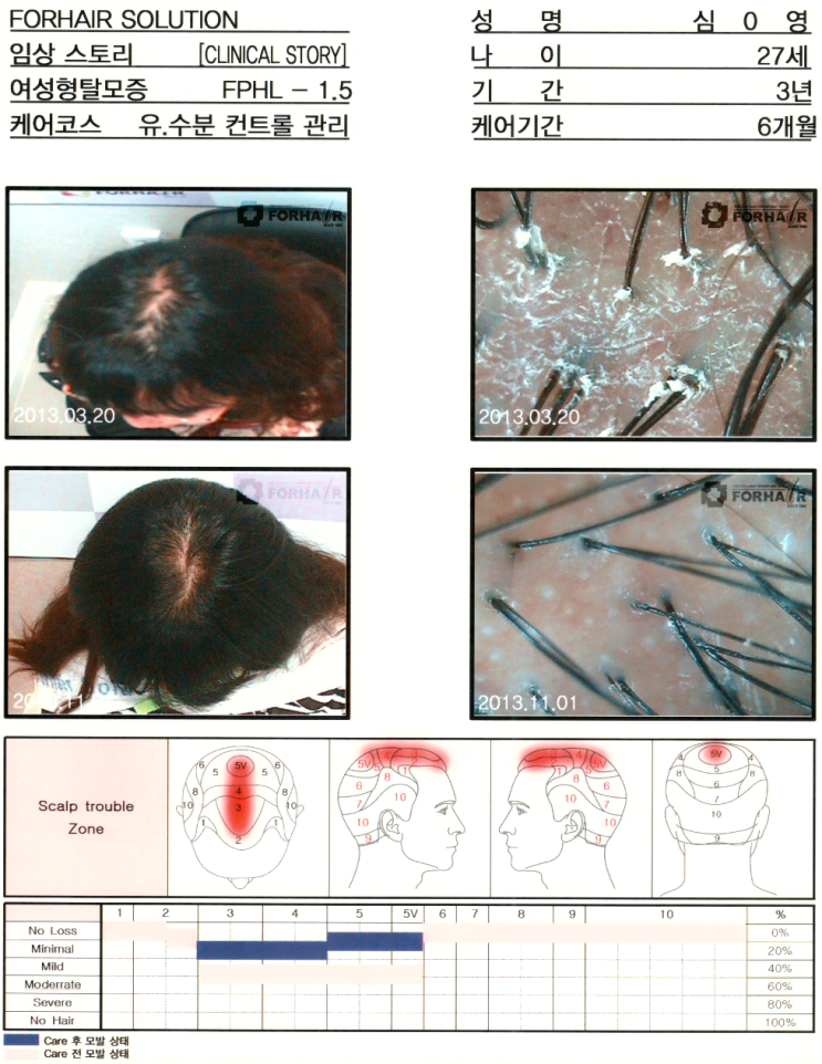 탈모증의 원인과 정의,마곡나루역 탈모,공항시장역 탈모,까치산역 탈모,강서구탈모,닥터포헤어,가양역점,탈모진단,탈모관리,탈모검사,두피관리