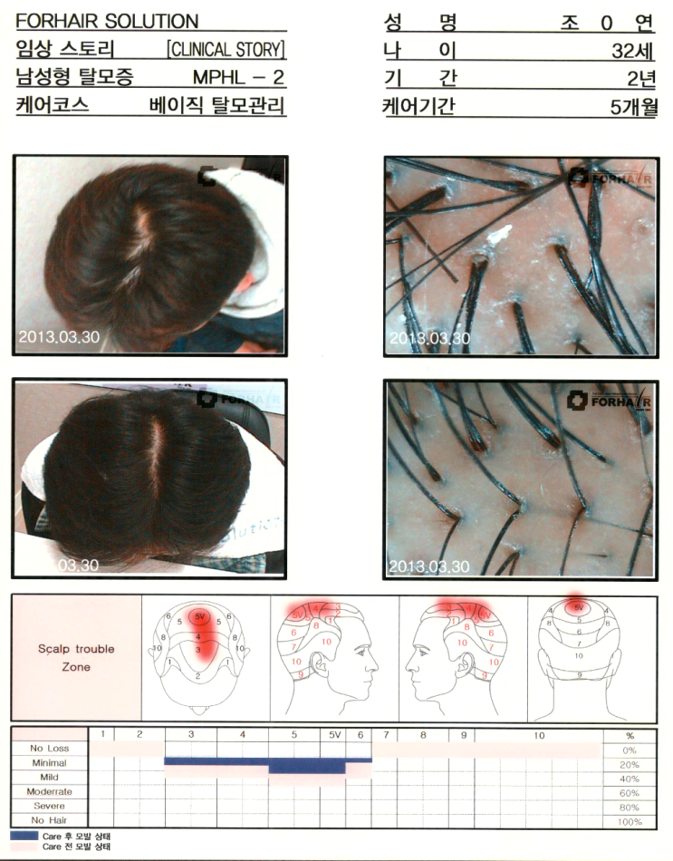 비반흥성 탈모의 원인과 예방과 관리방법,양천향교역탈모,증미역탈모,강서구탈모,닥터포헤어,가양역점,남성탈모증,여성탈모증,원형탈모증,탈모관리 비반흥성 탈모의 원인과 예방과 관리방법,양천향교역탈모,증미역탈모,강서구탈모,닥터포헤어,가양역점,남성탈모증,여성탈모증,원형탈모증,탈모관리