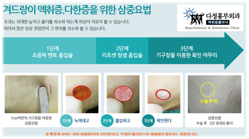 겨드랑이 액취증 수술 후 암내 완치가 가능한가요?