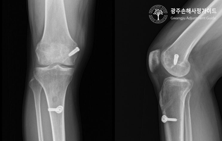 무릎, 전방십자인대파열 후유장해 보험금 보상 : 광주 손해사정 가이드