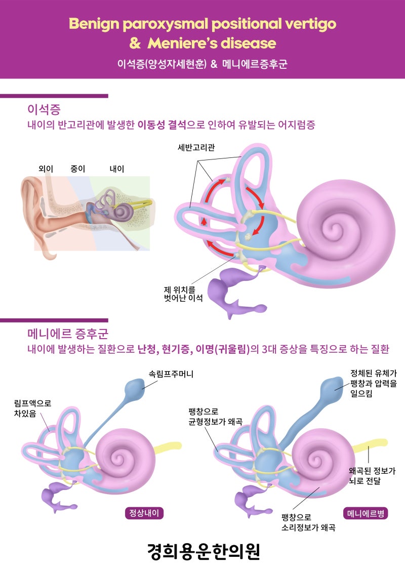 어지럼증 유발 귀질환(전정신경염, 메니에르병, 이석증)의 원인, 증상, 한의원 치료 / 메스꺼움, 귀먹먹, 난청 8