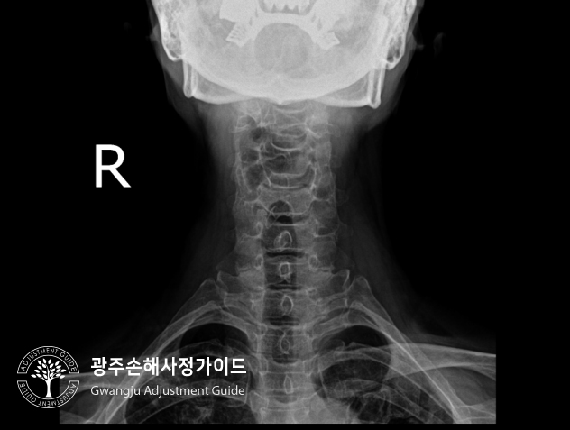 척추압박골절의 후유장해 보험금 분쟁 가이드 : 광주손해사정가이드