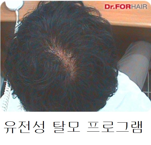 유전성 탈모 프로그램 유전성 탈모 프로그램