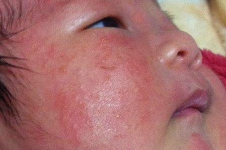 홍역 증상 설명, 아기 반려견 주의 사항, 치료 방법