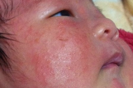  홍역 증상 설명, 아기 반려견 주의 사항, 치료 방법