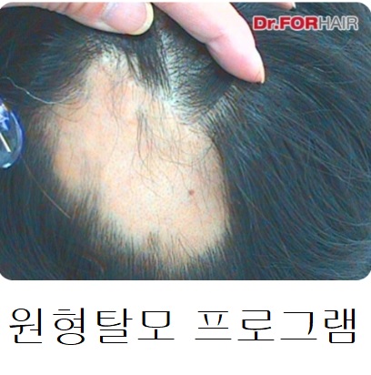 원형탈모 프로그램 원형탈모 프로그램