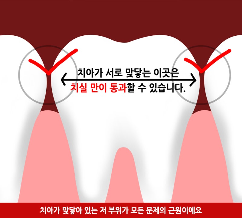 치과의사가 알려주는 올바른 치실 사용법_치실효과