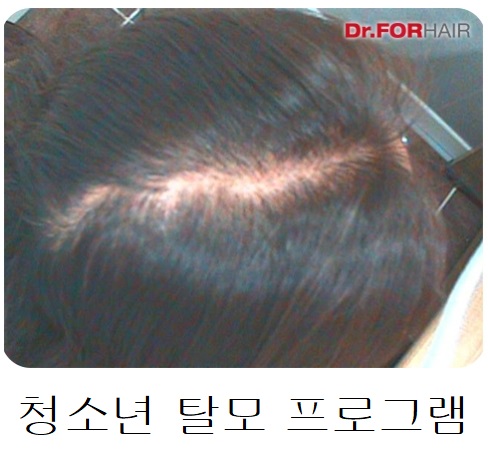 청소년 탈모 프로그램 청소년 탈모 프로그램