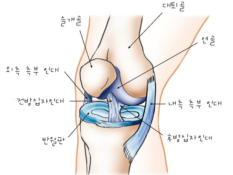 무릎통증 전방십자인대파열 수술과 치료, 퇴행성관절염(외상후성) 초래