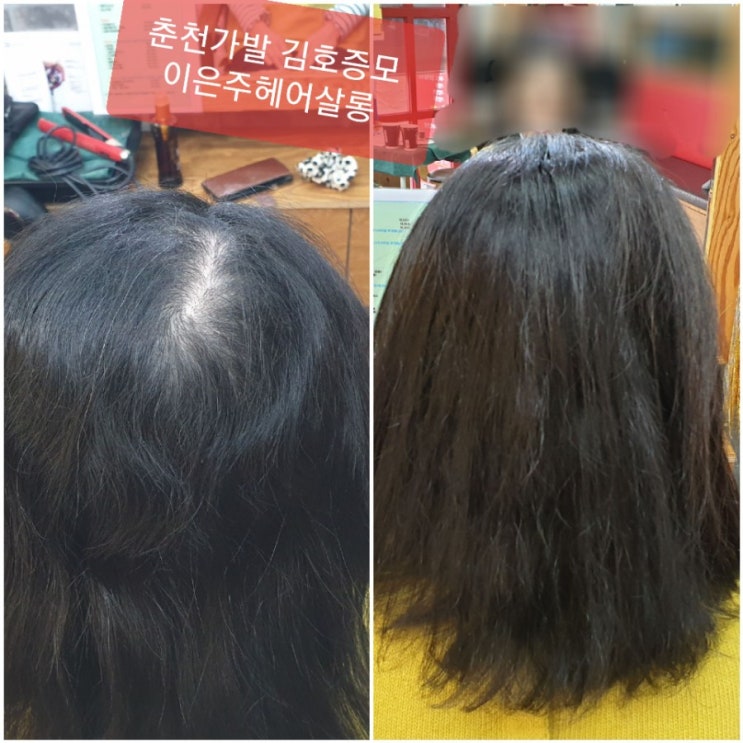 춘천가발ㆍ김호증모 다증모술과 보톡스증모술의 환상궁합으로 앞머리ㆍ 탑ㆍ 가르마 ㆍ정수리 숱보강 합니다~^^