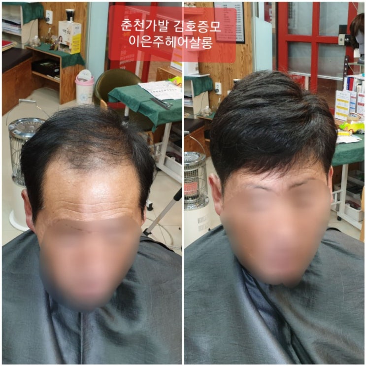  춘천가발 김호증모 춘천남자맞춤가발전문점 피팅하는 날~