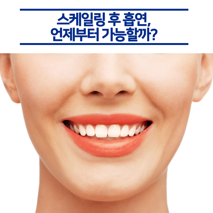  정기적으로 하는 스케일링 후 흡연, 언제부터 가능한가요?
