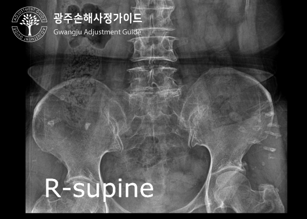 고관절골절 후유장해 보험금 보상받기 : 광주 손해사정 가이드 장한서