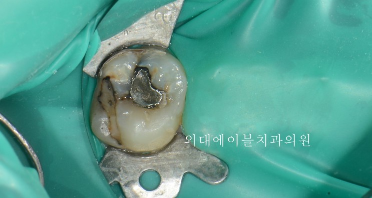 치아 레진 치료, 최소 삭제와 치아 보존