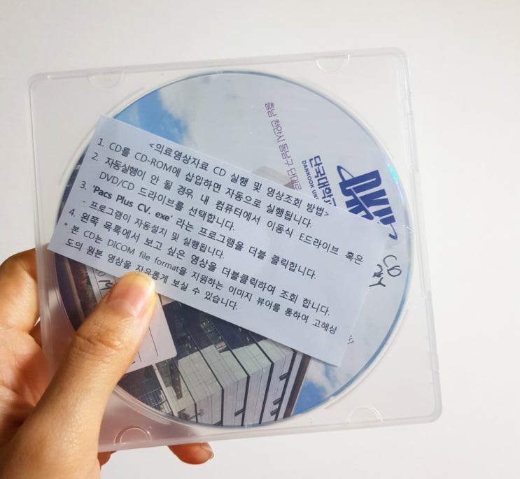  매복 수평 사랑니, 단국대학병원에서 빼려다 일반 치과에서 뺀 후기+ 1일, 2일차 붓기