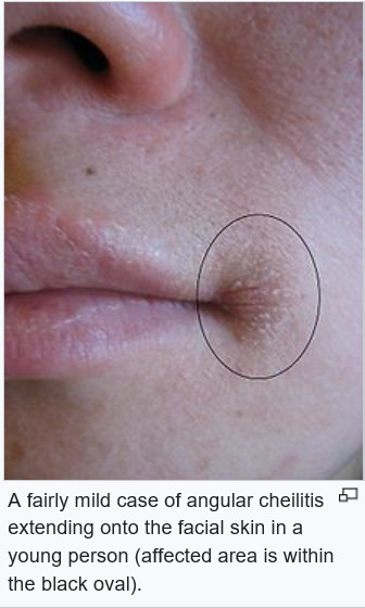 Angular Cheilitis 네이버 블로그