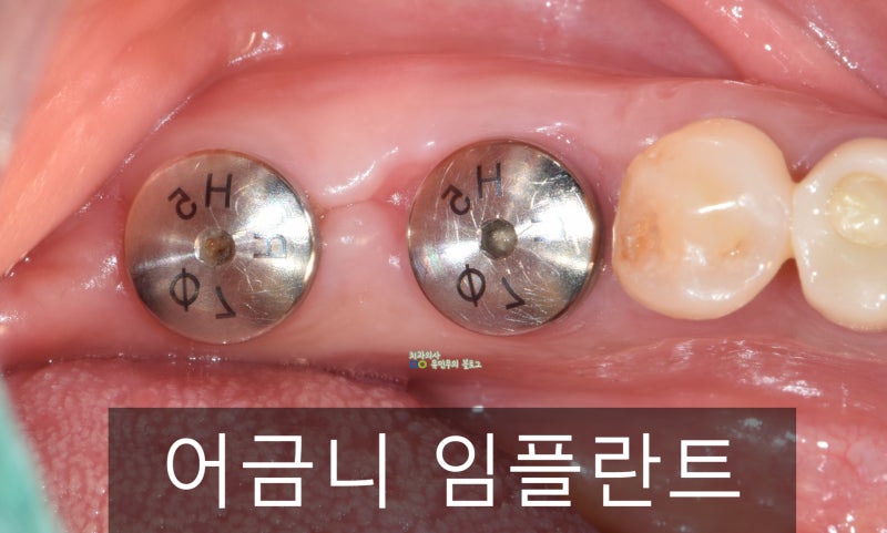 군산 임플란트의 건강한 치아, 잇몸 관리를 합시다.