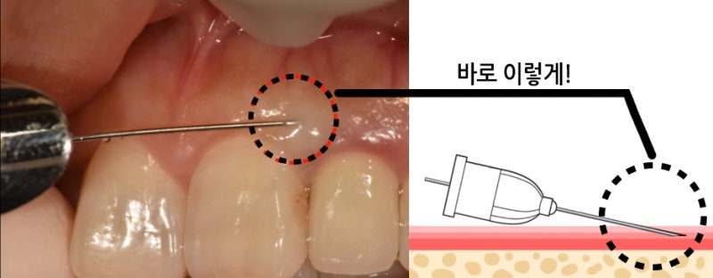 가산덜아픈치과 무통마취를 통한 치과치료 11