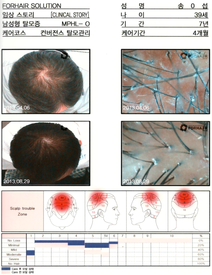 39세 남성,MPHL-O형,4개월 관리기간,등촌 탈모, "남성형, 여성형 탈모 유형", 등촌동 탈모 닥터포헤어 가양역점. 등촌역 탈모 두피 각질 건선 관리. 39세 남성,MPHL-O형,4개월 관리기간,등촌 탈모, "남성형, 여성형 탈모 유형", 등촌동 탈모 닥터포헤어 가양역점. 등촌역 탈모 두피 각질 건선 관리.