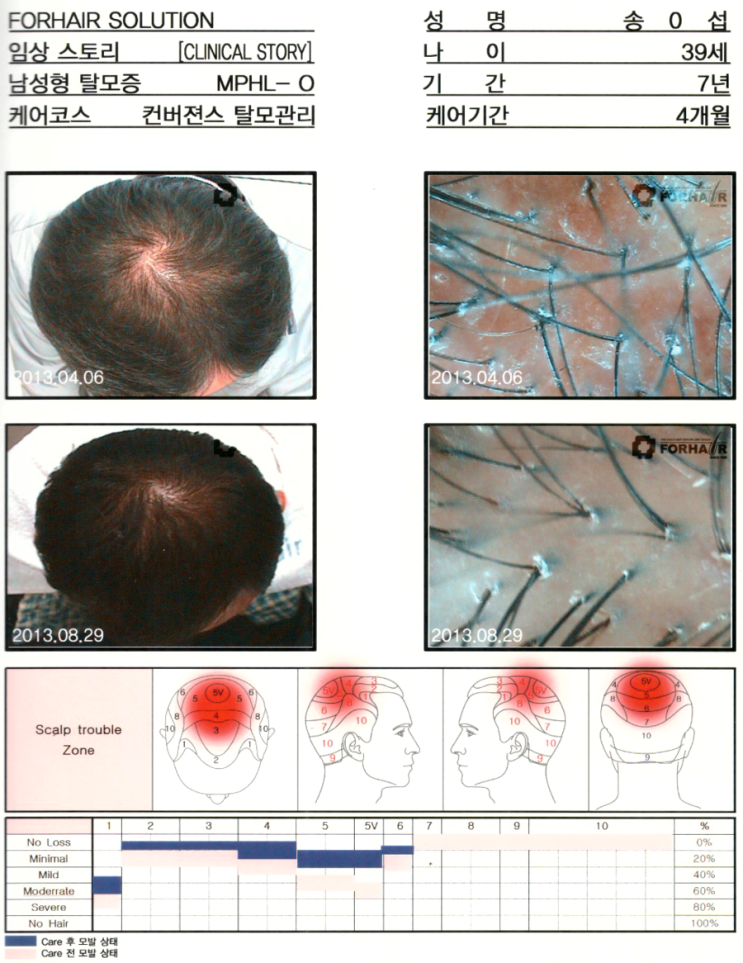 39세 남성,MPHL-O형,4개월 관리기간,등촌 탈모, "남성형, 여성형 탈모 유형", 등촌동 탈모 닥터포헤어 가양역점. 등촌역 탈모 두피 각질 건선 관리.