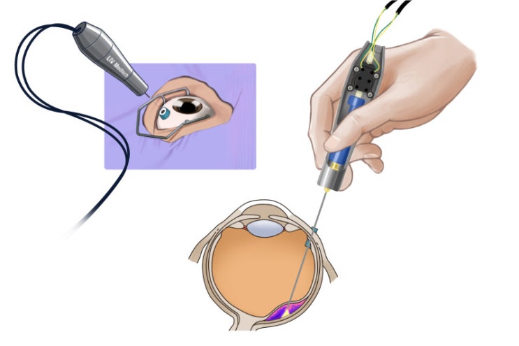  [일러스트] 안과수술_injector
