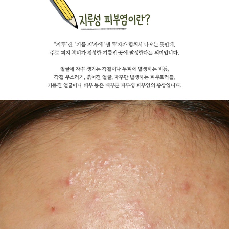수원지루성 피부염을 과다하게 만들 정도의 유분이